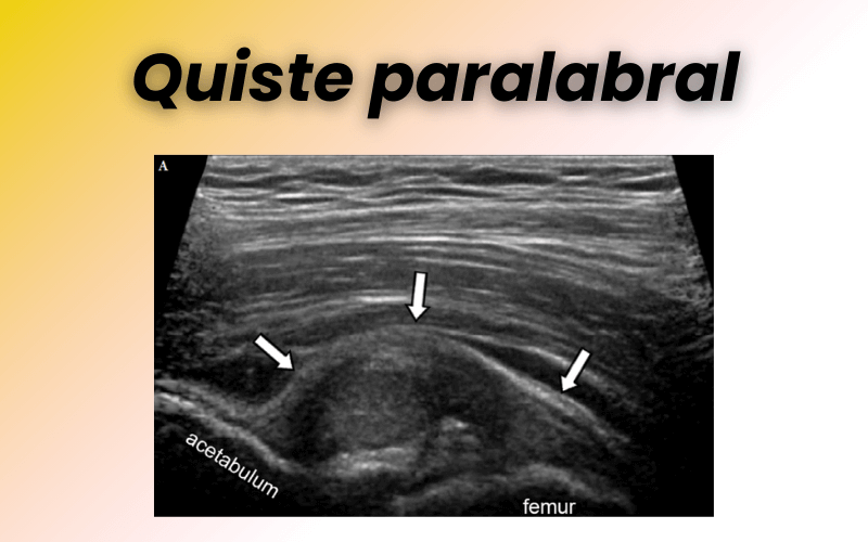 2. Patologia compartimento anterior cadera tempo formacion.png